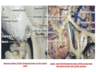The temporal bone and transtemporal approaches | PPTX