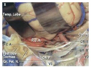The temporal bone and transtemporal approaches | PPTX