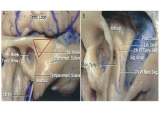 The temporal bone and transtemporal approaches | PPTX