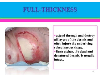 extend through and destroy
all layers of the dermis and
often injure the underlying
subcutaneous tissue.
Burn eschar, the dead and
denatured dermis, is usually
intact..

12

 