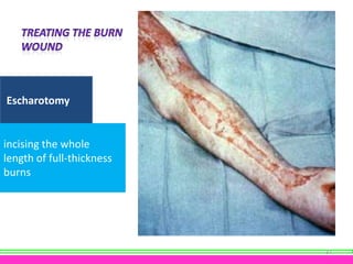 Escharotomy

incising the whole
length of full-thickness
burns

37

 