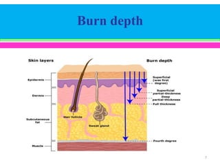 Burn depth

7

 