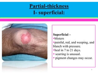 Partial-thickness
I- superficial:

Superficial –
blisters
painful, red, and weeping, and
blanch with pressure.
heal in 7 to 21 days.
 scarring is unusual.
 pigment changes may occur.

9

 