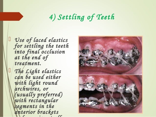 Settling Elastics In Orthodontics Outlet 54 Off Www Ingeniovirtual Com Settling Elastics In Orthodontics Outlet 54 Off Www Ingeniovirtual Com