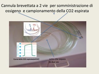 Cannula brevettata a 2 vie per somministrazione di 
ossigeno e campionamento della CO2 espirata 
setto che separa 
le due vie 
Curva della CO2 espirata(etCO2) 
 