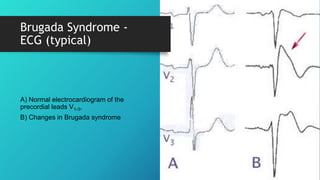 Brugada Syndrome -
ECG (typical)
A) Normal electrocardiogram of the
precordial leads V1-3,
B) Changes in Brugada syndrome
 