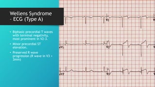 Wellens Syndrome
– ECG (Type A)
• Biphasic precordial T waves
with terminal negativity,
most prominent in V2-3.
• Minor precordial ST
elevation.
• Preserved R wave
progression (R wave in V3 >
3mm)
 