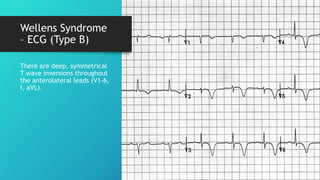 Wellens Syndrome
– ECG (Type B)
There are deep, symmetrical
T wave inversions throughout
the anterolateral leads (V1-6,
I, aVL).
 