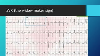 aVR (the widow maker sign)
 