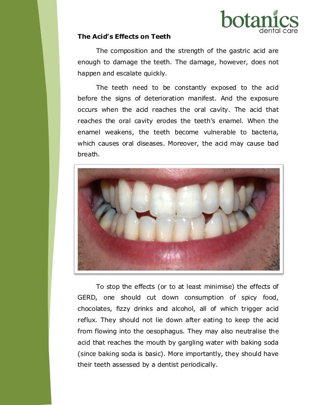 The Unexpected Effects of Acid Reflux on Dental Health