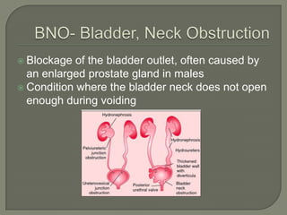 Blockage of the bladder outlet, often caused by
an enlarged prostate gland in males
Condition where the bladder neck does not open
enough during voiding