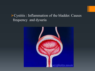 Cystitis : Inflammation of the bladder. Causes
frequency and dysuria
 