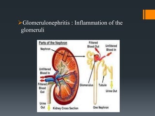 Glomerulonephritis : Inflammation of the
glomeruli
 