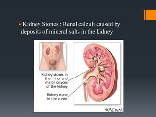 Kidney Stones : Renal calculi caused by
deposits of mineral salts in the kidney
 