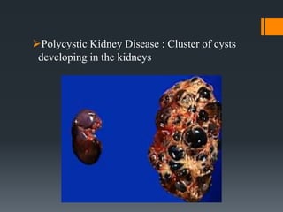Polycystic Kidney Disease : Cluster of cysts
developing in the kidneys
 