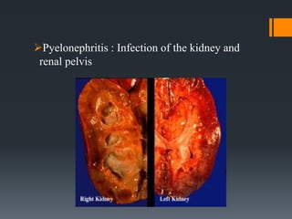 Pyelonephritis : Infection of the kidney and
renal pelvis
 