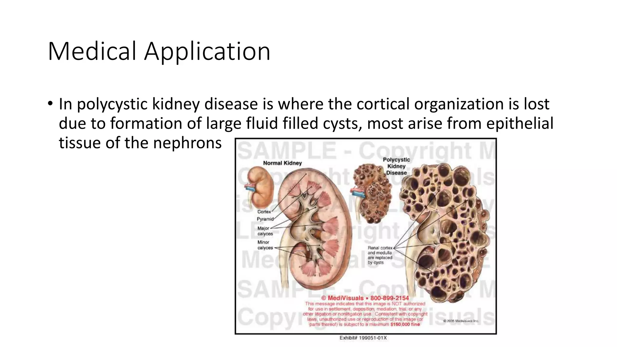 Medical Application
• In polycystic kidney disease is where the cortical organization is lost
due to formation of large fluid filled cysts, most arise from epithelial
tissue of the nephrons
 