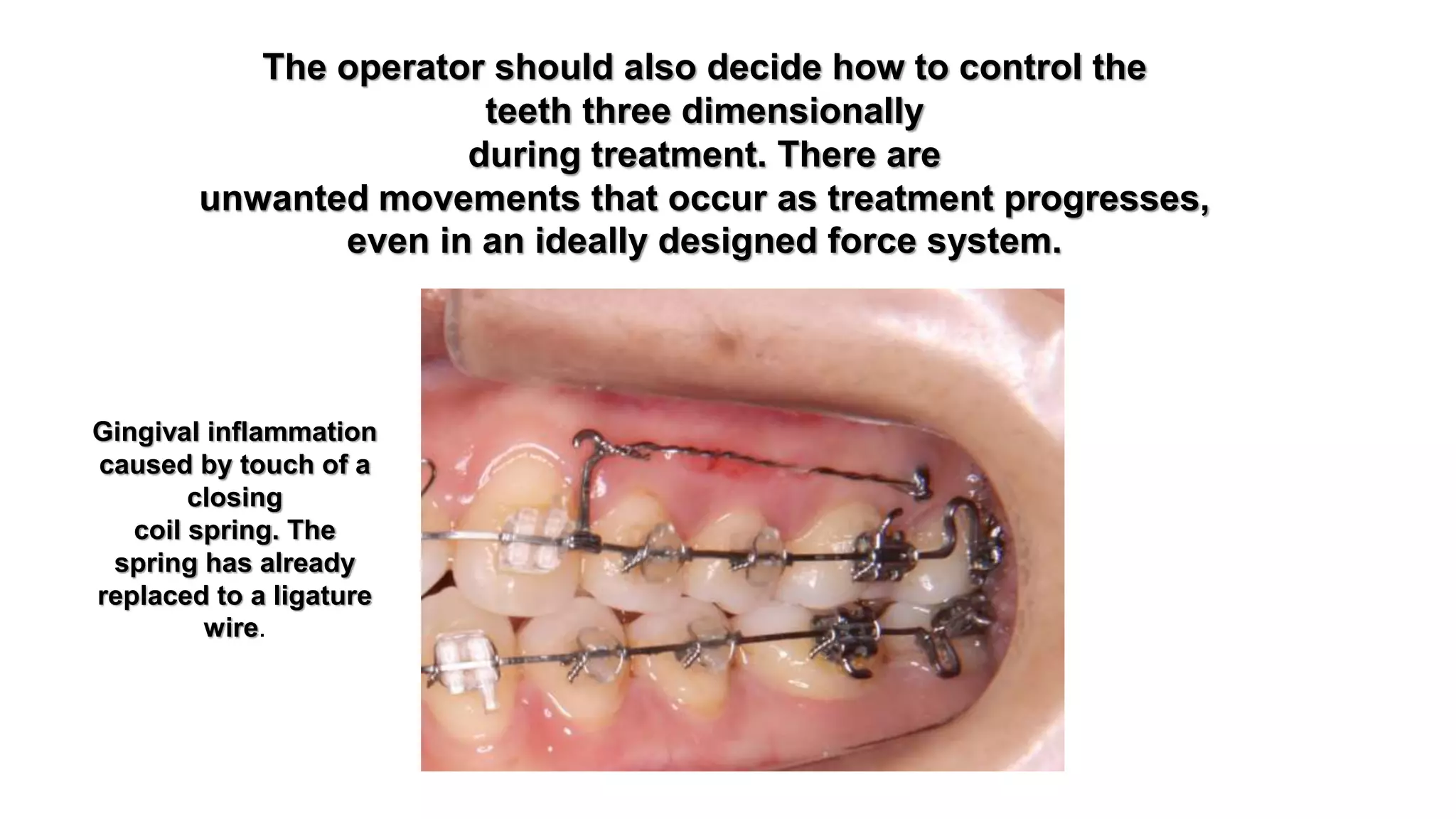 The use of microimplants in orthodontics | PPTX