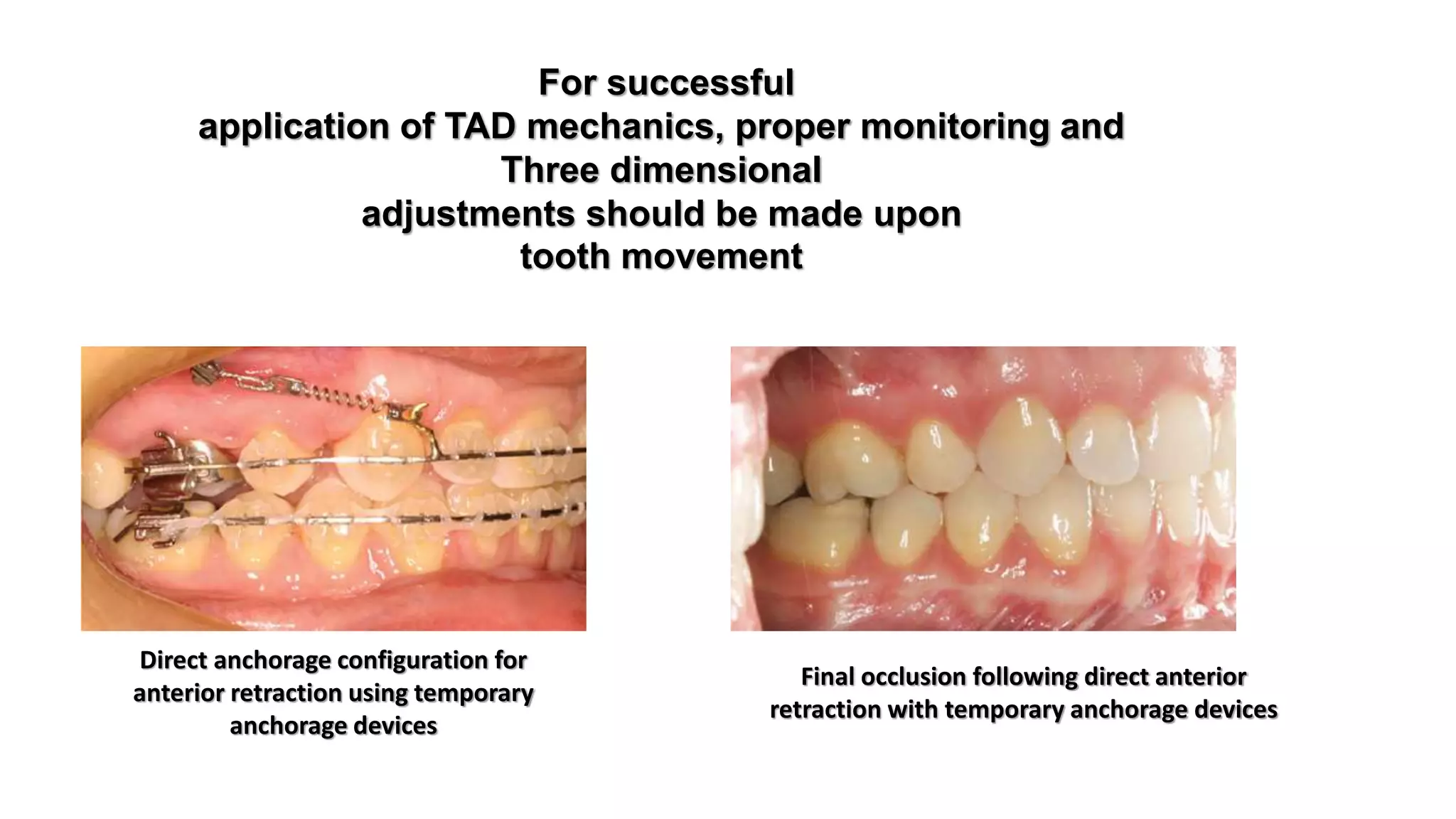 The use of microimplants in orthodontics | PPTX