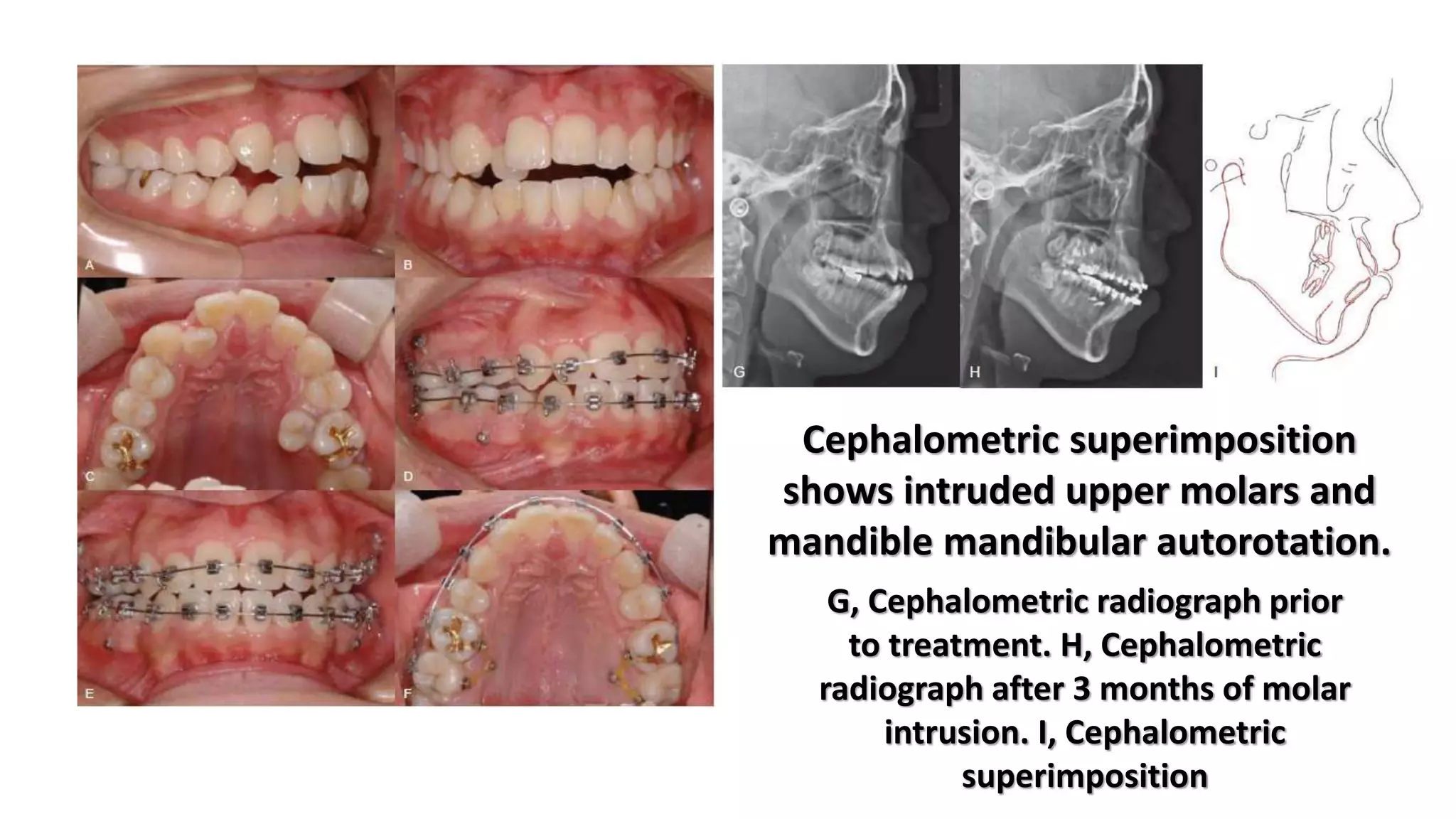 The use of microimplants in orthodontics | PPTX