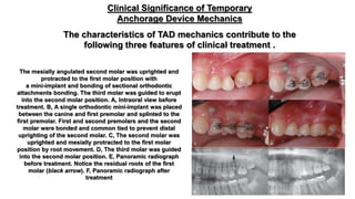 Messially Angulated The use of microimplants in orthodontics | PPTX
