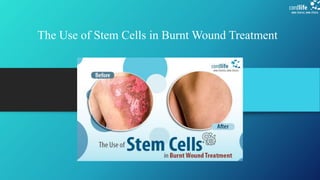 The Use of Stem Cells in Burnt Wound Treatment
 