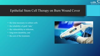 The use of stem cells in burnt wound treatment | PPTX
