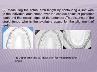 The uses of orthodontic study models in DIAGNOSIS AND TREATMENT ...