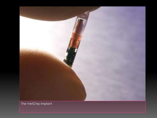 The VeriChip implant