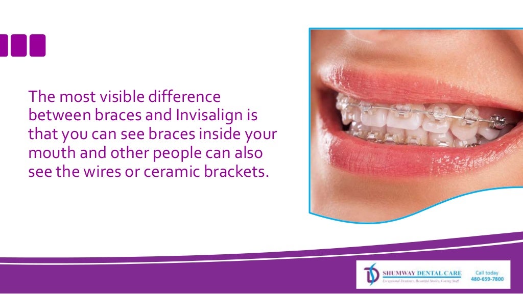 The Visible Difference Between Invisalign and Braces