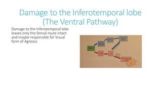 Damage to the Inferotemporal lobe
(The Ventral Pathway)
Damage to the Inferotemporal lobe
leaves only the Dorsal route intact
and maybe responsible for Visual
form of Agnosia
 