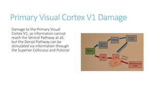 Primary Visual Cortex V1 Damage
Damage to the Primary Visual
Cortex V1, so information cannot
reach the Ventral Pathway at all,
but the Dorsal Pathway can be
stimulated via information through
the Superior Colliculus and Pulvinar
 