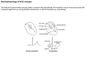 Electrophysiology of ECG changes
The features of pre-excitation may be subtle, or present only intermittently. Pre-excitation may be more pronounced with
increased vagal tone e.g. during Valsalva manoeuvres, or with AV blockade e.g. drug therapy.
 