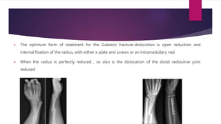  The optimum form of treatment for the Galeazzi fracture-dislocation is open reduction and
internal fixation of the radius, with either a plate and screws or an intramedullary nail
 When the radius is perfectly reduced , so also is the dislocation of the distal radioulnar joint
reduced
 