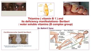 Thiamine ( vitamin B 1 ) and
its deficiency manifestations- Beriberi
: water soluble vitamins (B complex group)
Dr. Rohini C Sane
 