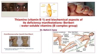 Thiamine (vitamin B 1) and biochemical aspects of
its deficiency manifestations- Beriberi
: water soluble vitamins (B complex group)
Dr. Rohini C Sane
 