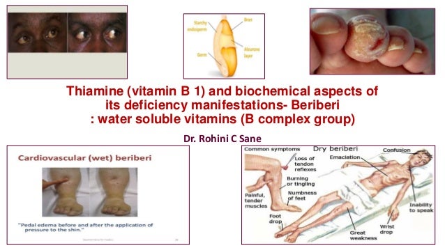 Thiamine Vitamin B1 And Biochemical Aspects Of Beriberi