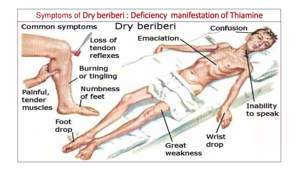 Thiamine (vitamin B1) and biochemical aspects of beriberi