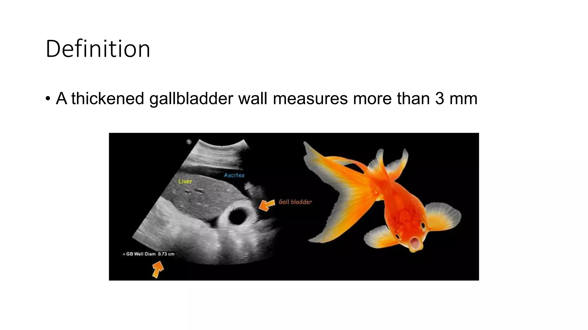 Thick walled Gall Bladder.pptx