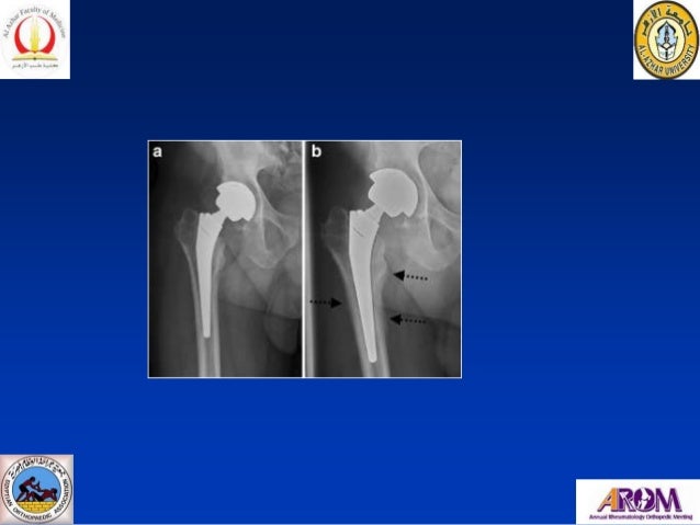 Thigh Pain After Total Hip Arthroplasty autosaved 