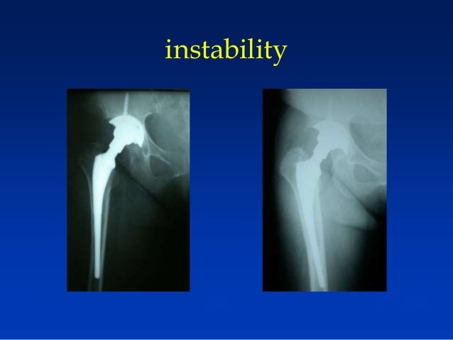 Thigh Pain After Total Hip Arthroplasty autosaved 