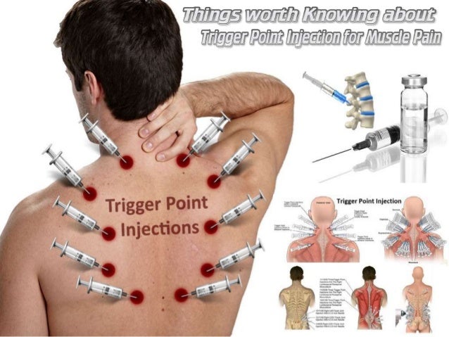 Trigger Point Injection Sites