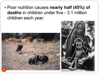  Poor nutrition causes nearly half (45%) of
deaths in children under five - 3.1 million
children each year.
12
 
