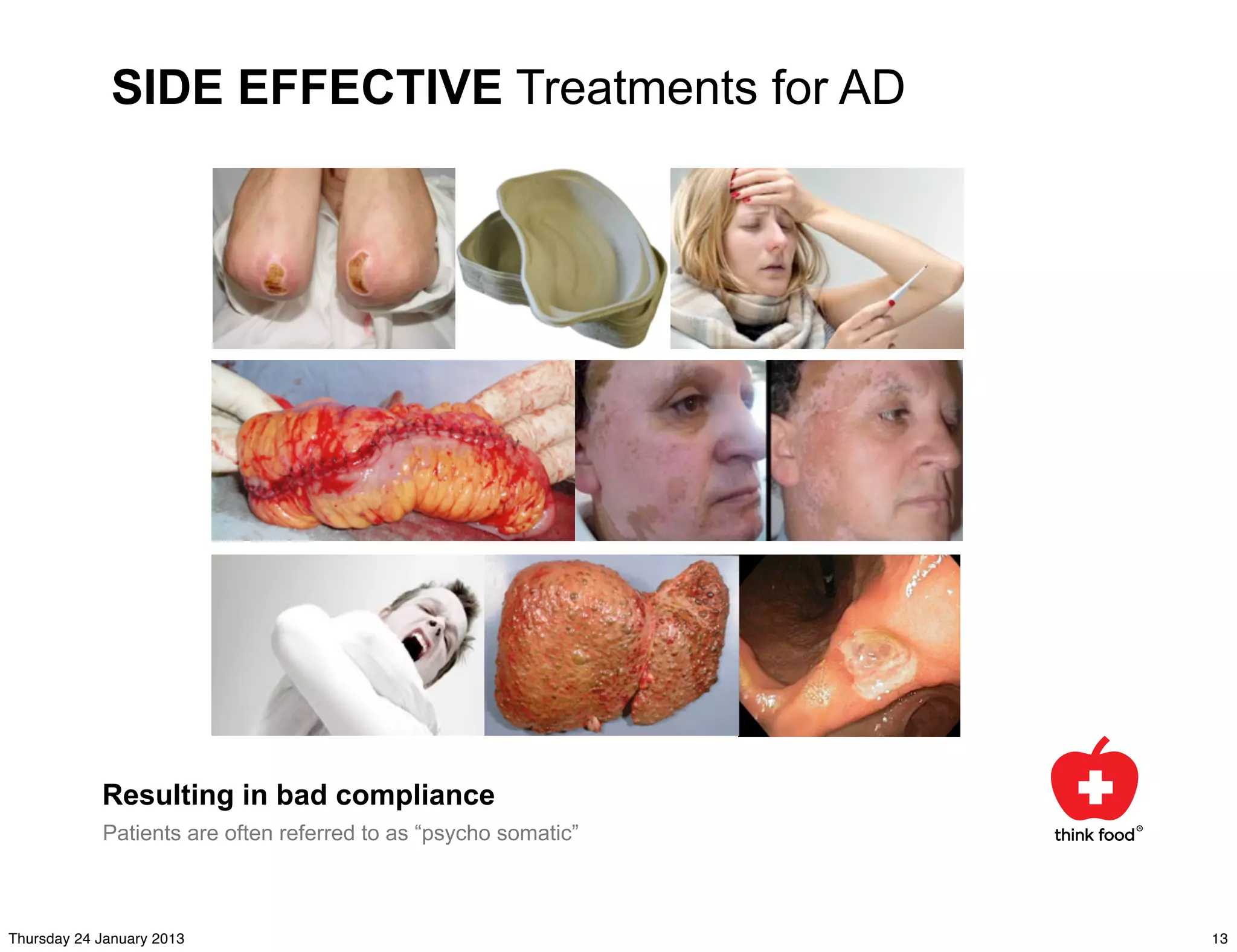 SIDE EFFECTIVE Treatments for AD




            Resulting in bad compliance
            Patients are often referred to as “psycho somatic”



Thursday 24 January 2013                                         13
 