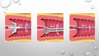 BRUSH
Insert the central bristles of the brush into the
endocervical canal so that the bottom of the
brush is visible at b...