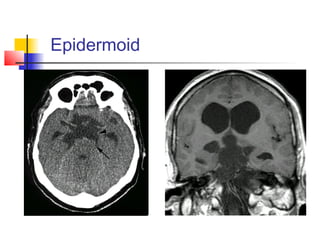 Epidermoid
 