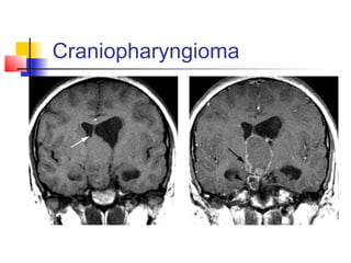 Craniopharyngioma
 