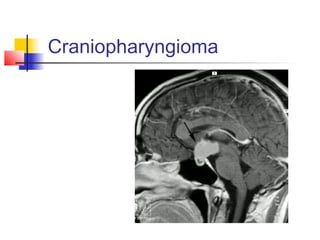 Craniopharyngioma
 