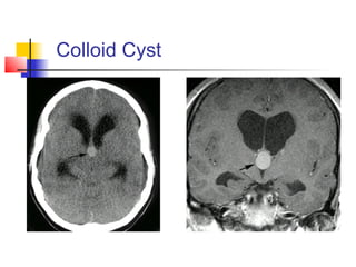 Colloid Cyst
 
