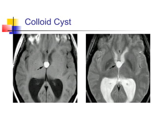 Colloid Cyst
 